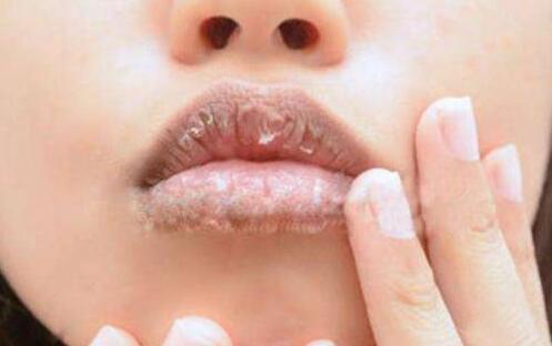 嘴唇干裂脱皮是什么原因？四个常见原因别不当回事